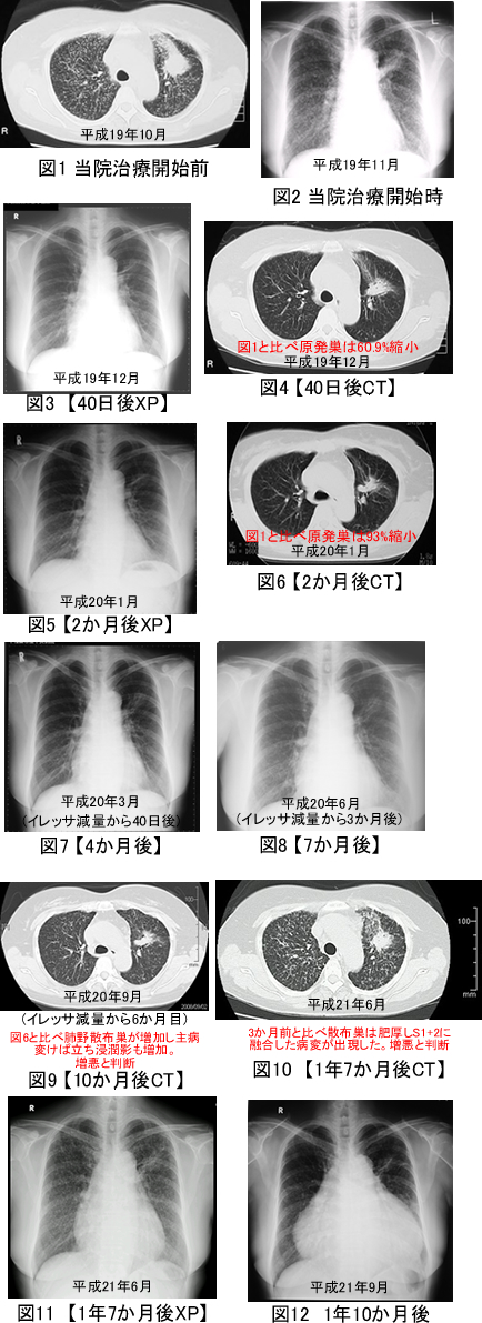 肺腺癌　粟粒性肺転移　CT検査レントゲン画像の推移