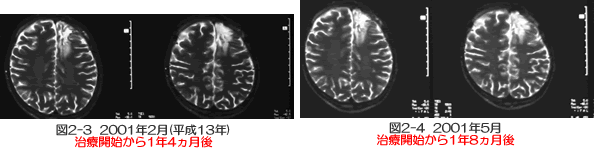 脳腫瘍 症例 多発性神経膠芽腫　MRI比較画像②