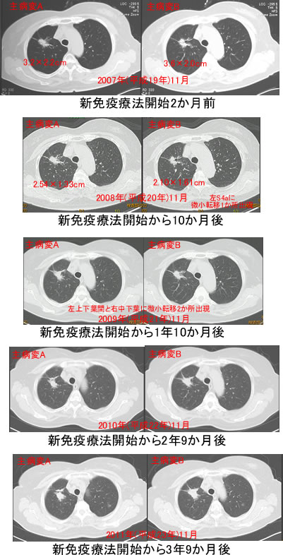 肺腺癌CT画像の推移