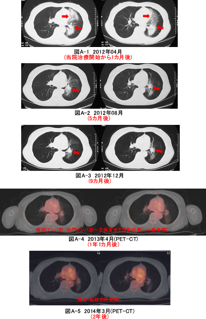小細胞肺がんCT検査画像の推移