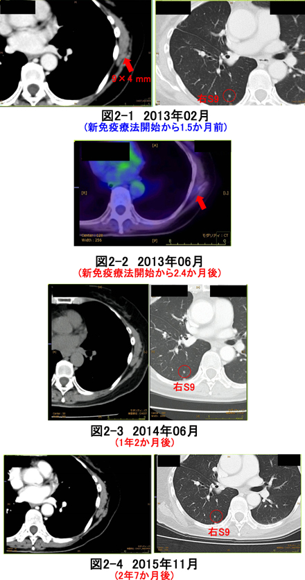 肺腺癌　再発　CT画像比較