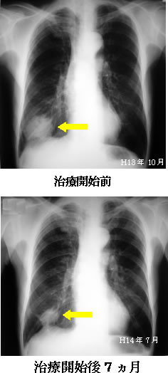 レントゲン写真の推移　肺扁平上皮癌