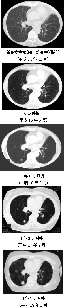 肺腺癌CT　検査画像の推移