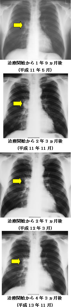 肺扁平上皮癌　レントゲン写真の推移