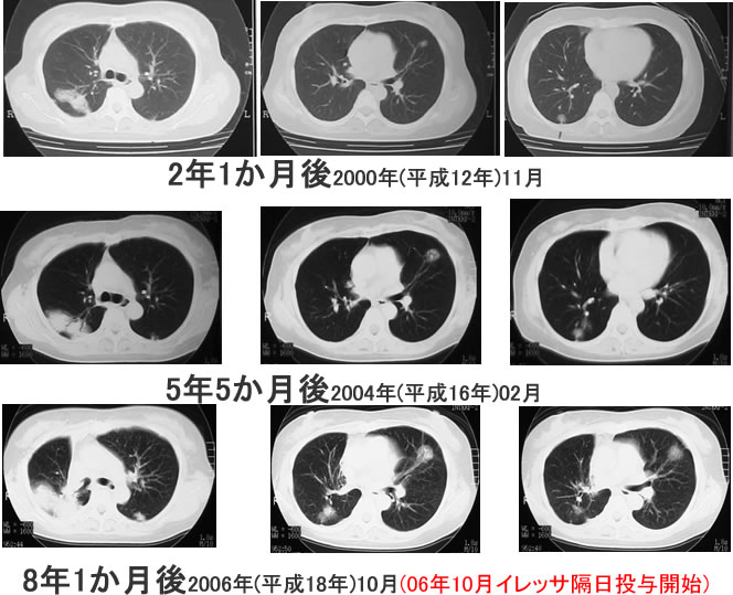CT検査画像の推移肺腺癌
