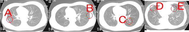 肺扁平上皮癌　CT画像1