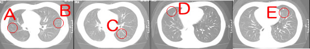 肺扁平上皮癌　CT画像の推移2
