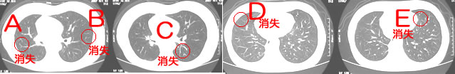 肺扁平上皮癌　CT検査画像の推移3