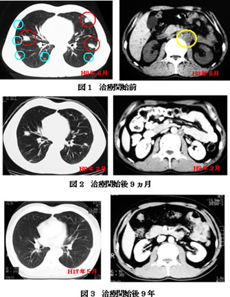 精巣癌　肺転移　CT検査画像の推移