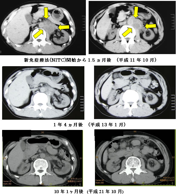 精巣癌　CT検査画像　比較2