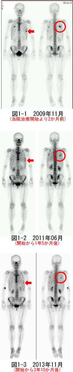 乳癌骨転移の比較画像