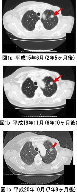 乳癌　肺転移　症例　CT画像比較