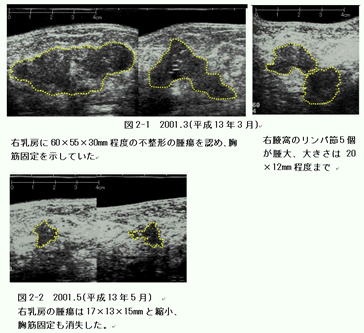 乳がん　症例　超音波検査画像比較1