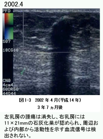 乳がん　症例　比較画像3　超音波検査