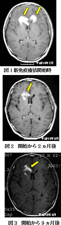 脳腫瘍 星状細胞腫瘍と胚細胞腫瘍 症例　CT比較画像
