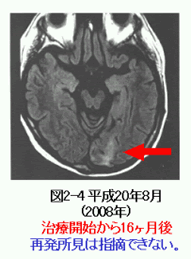 脳腫瘍 HCG産生脳腫瘍 MRI比較画像②　新免疫療法によるがん免疫療法