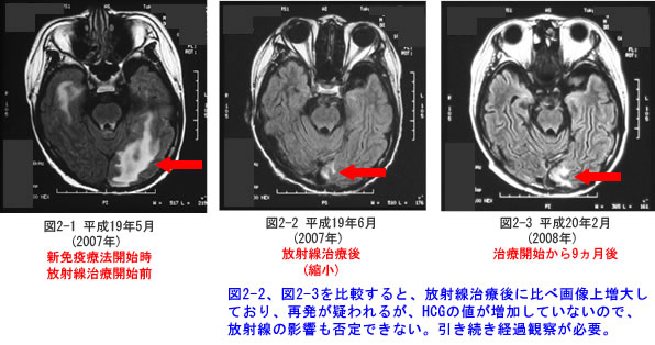 脳腫瘍 HCG産生脳腫瘍 MRI比較画像①　新免疫療法によるがん免疫療法