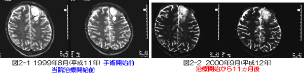 脳腫瘍 症例 多発性神経膠芽腫　MRI比較画像①