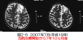 脳腫瘍 症例 多発性神経膠芽腫　MRI比較画像③