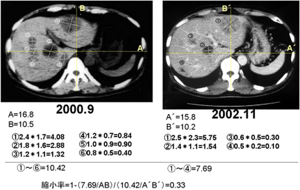 膵臓癌　肝転移　症例　CT検査画像の比較